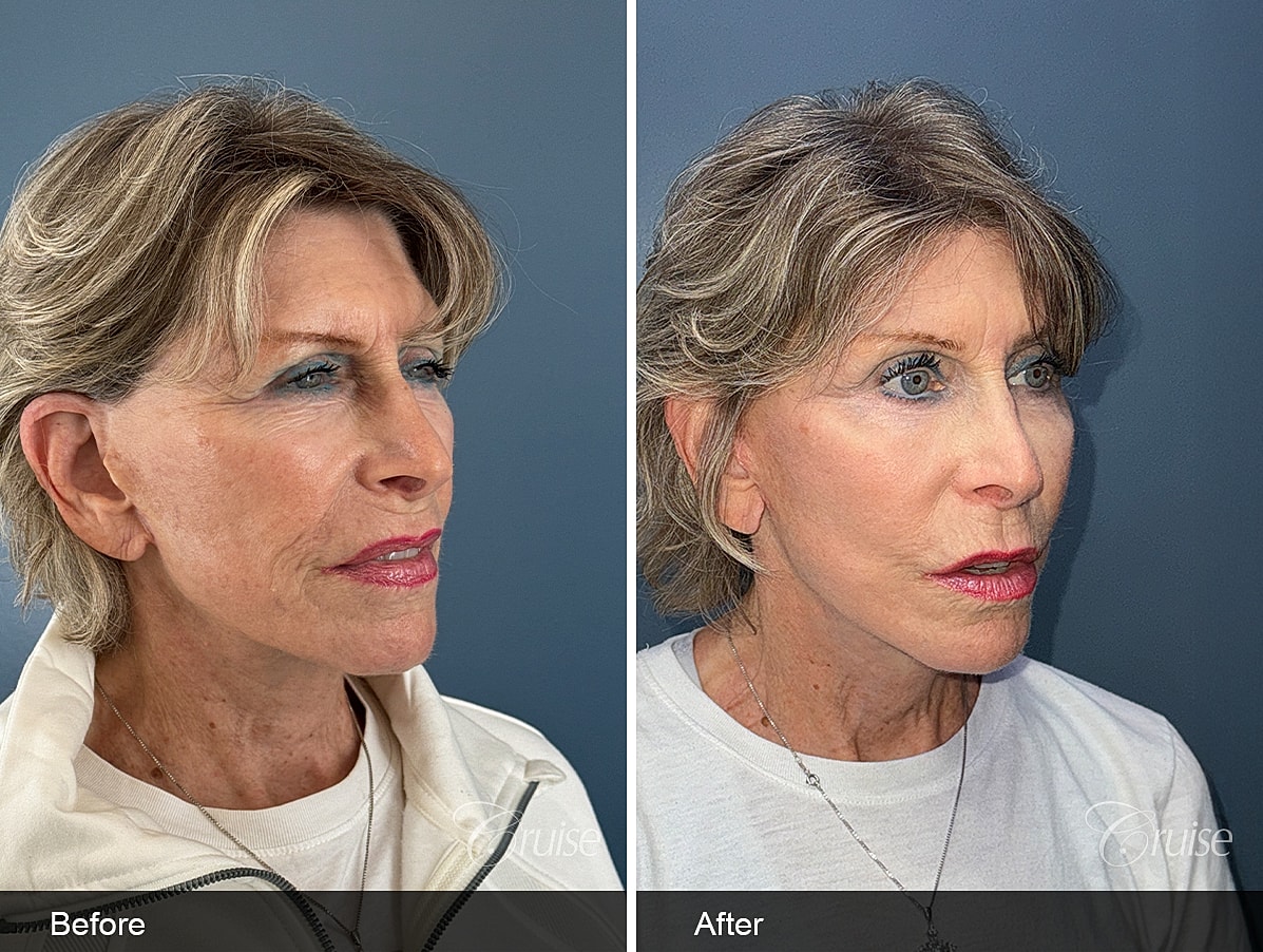 Face Lift Before & After