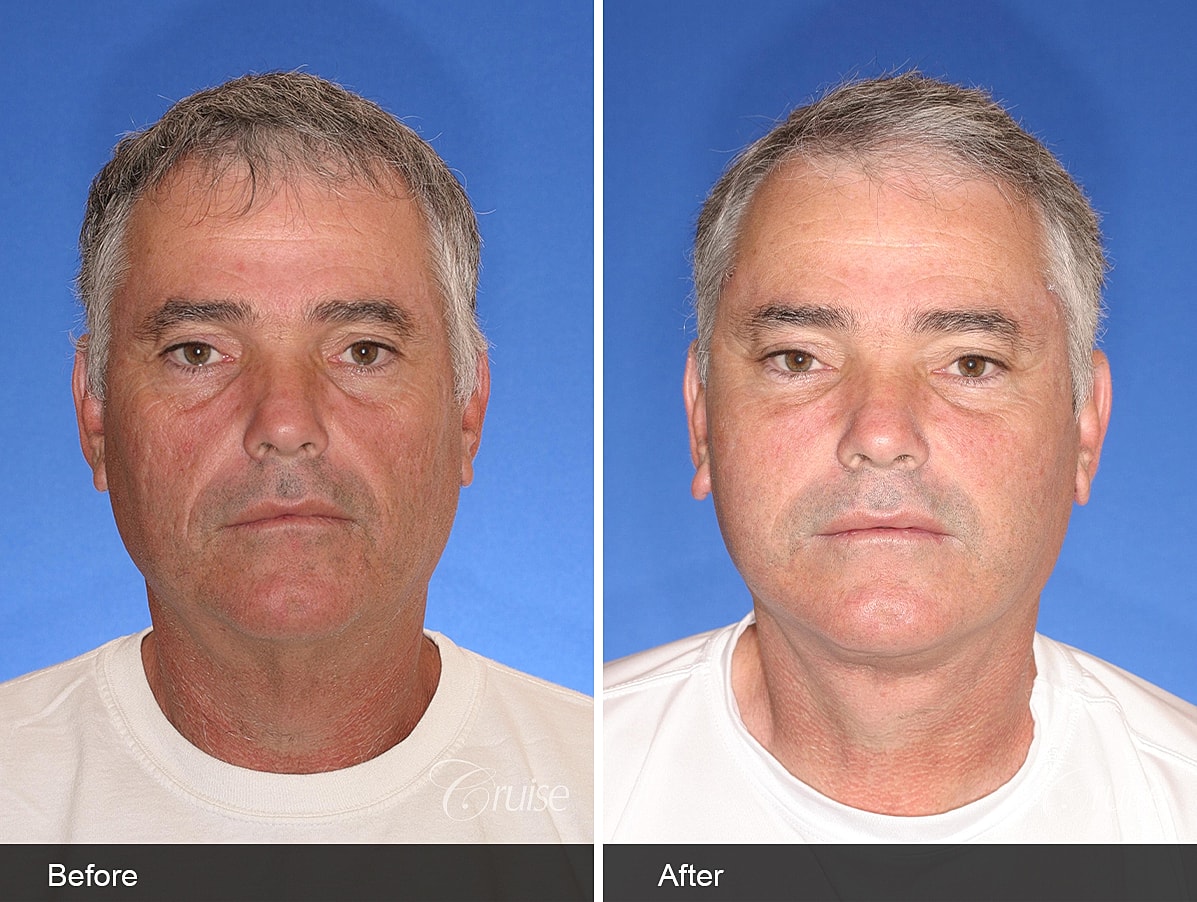 Face Lift Before & After