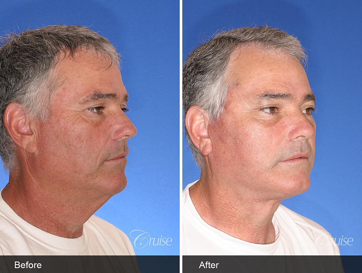 Face Lift Before & After