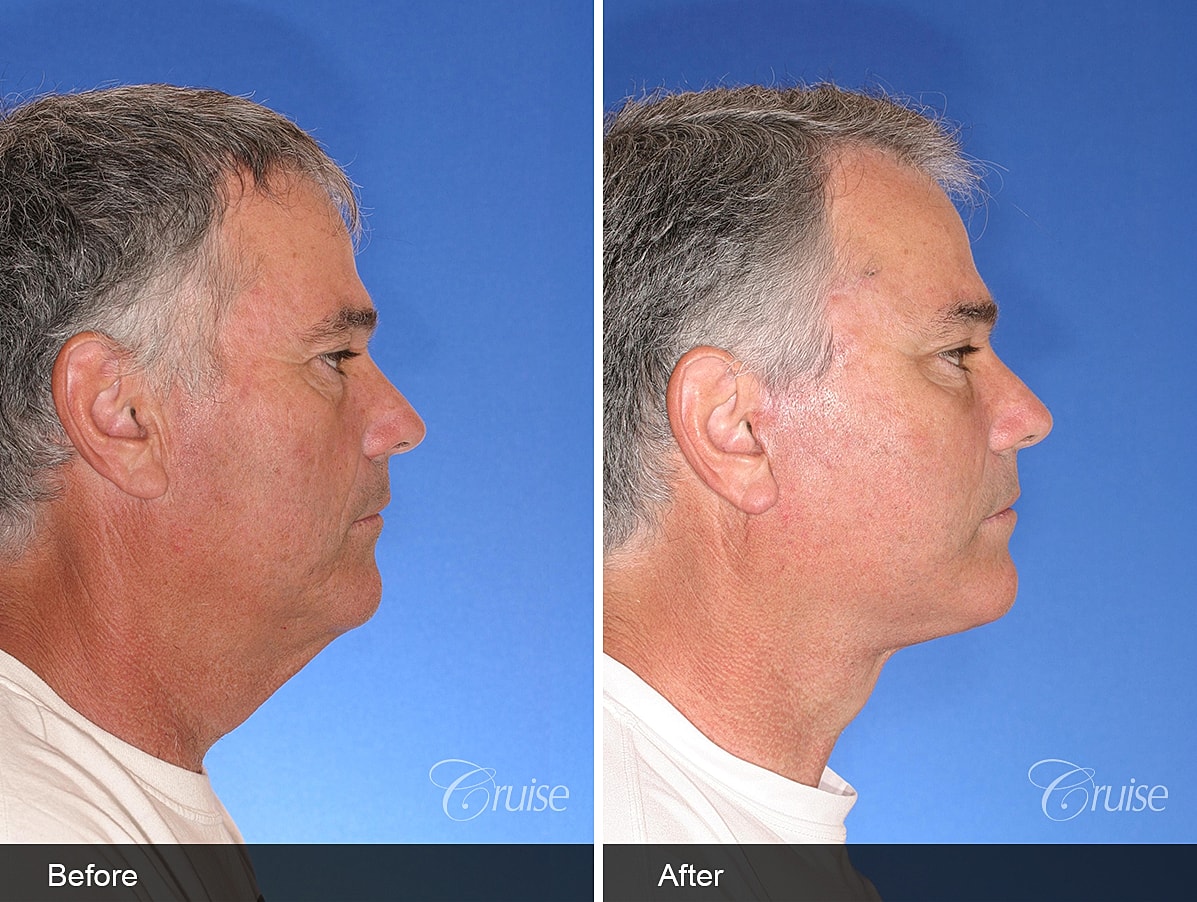 Face Lift Before & After