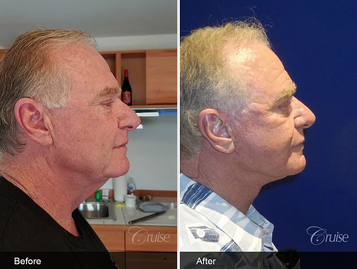 Face Lift Before & After