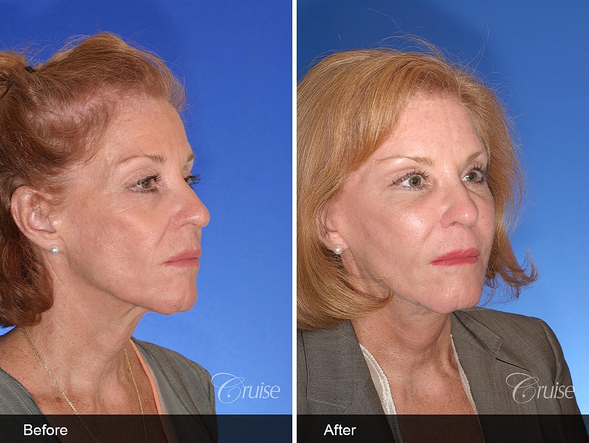 Face Lift Before & After