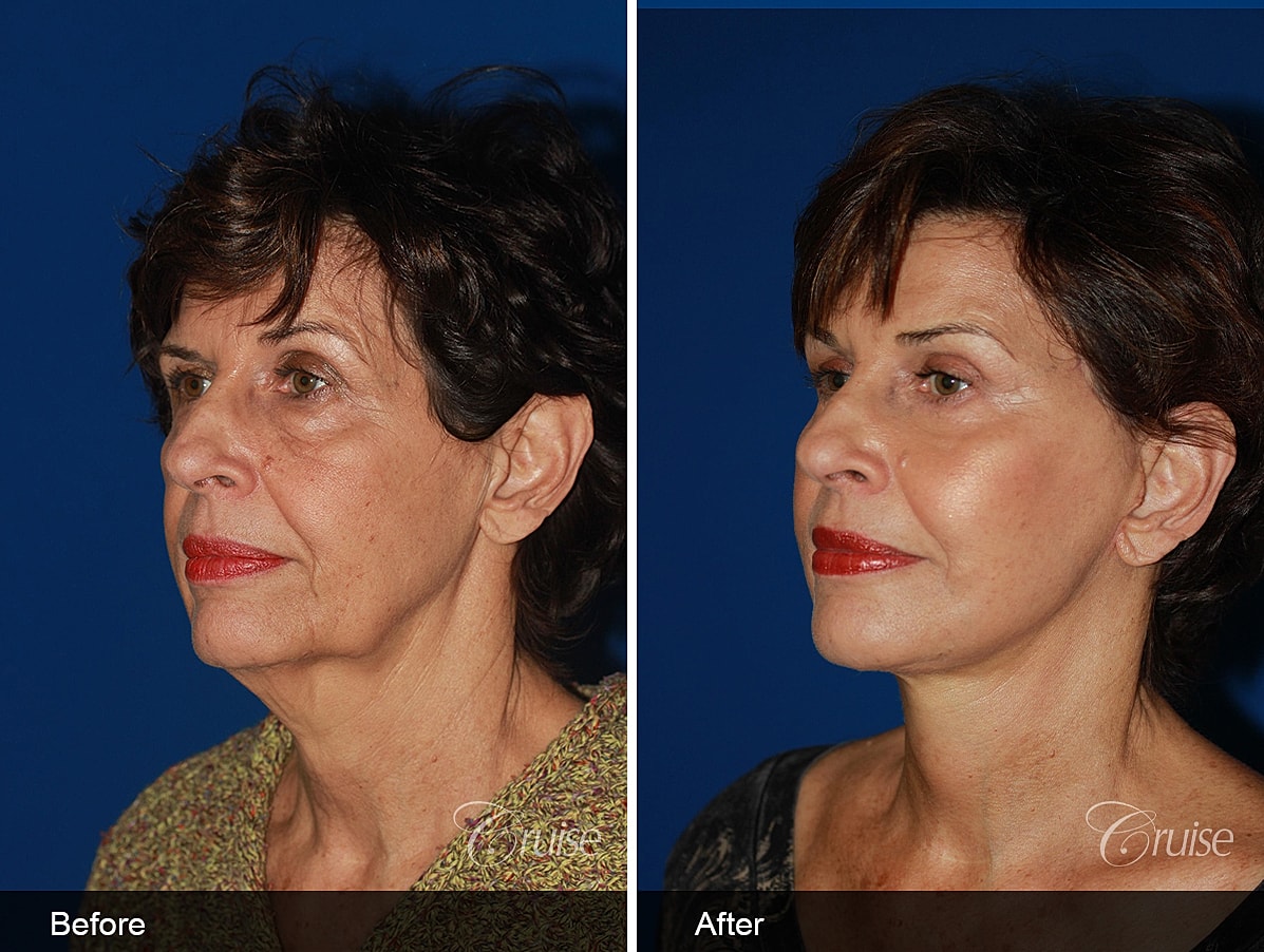 Face Lift Before & After