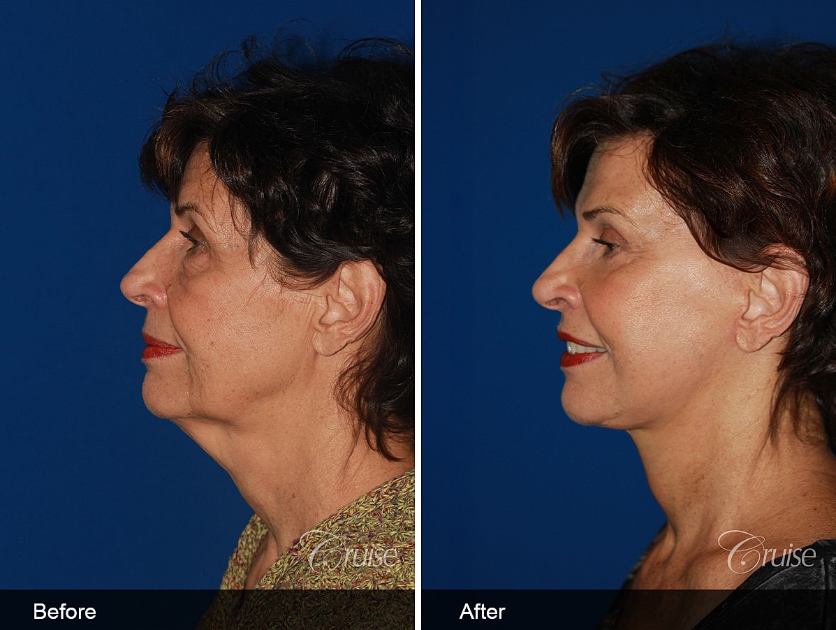 Face Lift Before & After