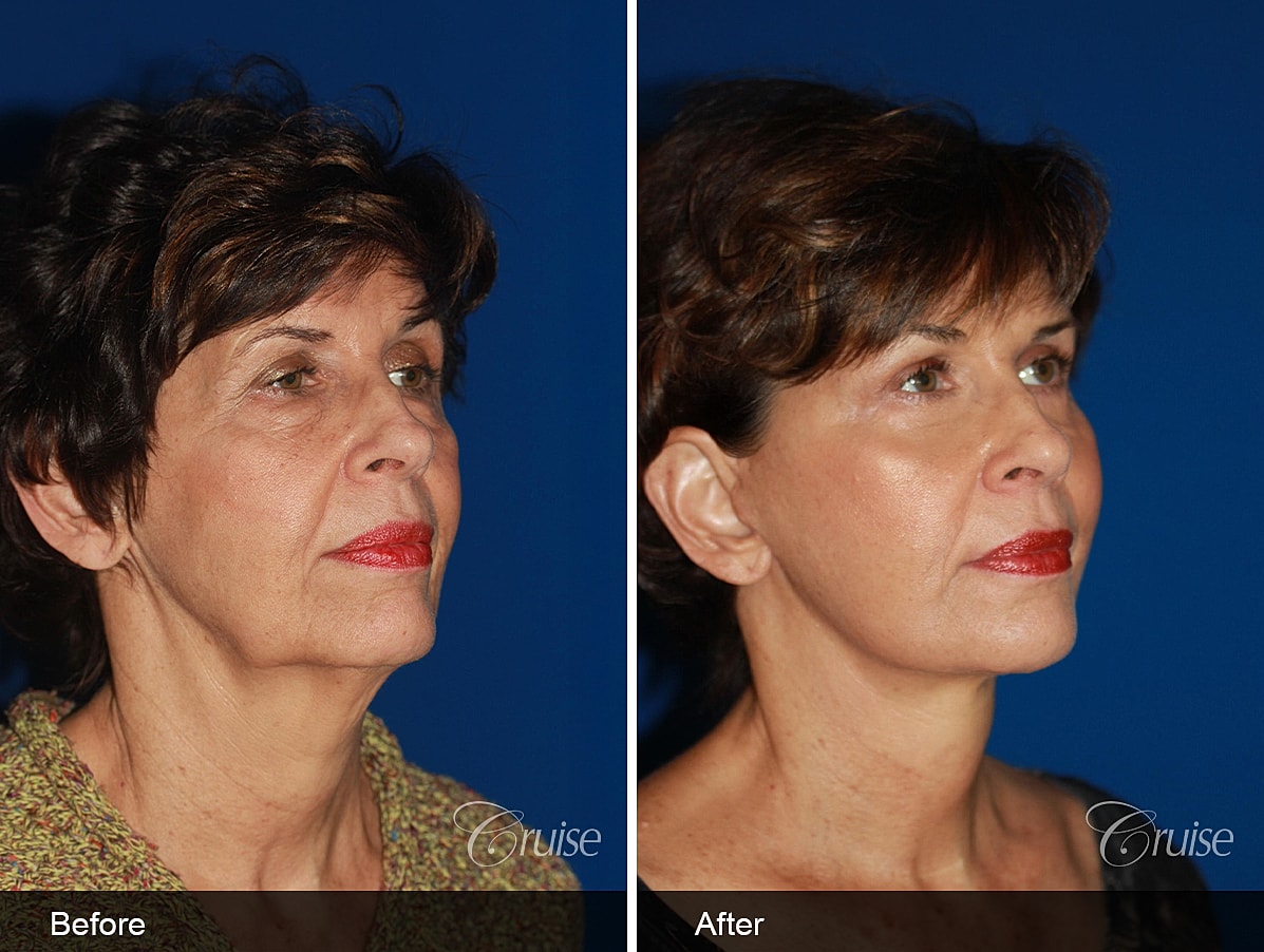 Face Lift Before & After