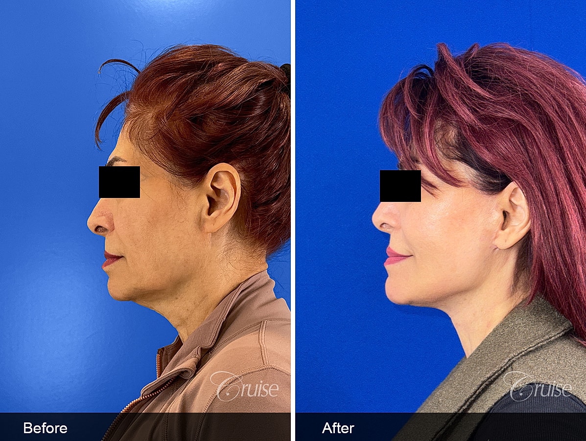 Face Lift Before & After