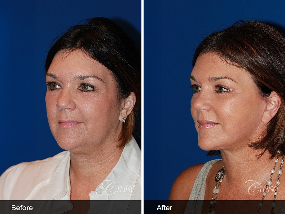 Face Lift Before & After