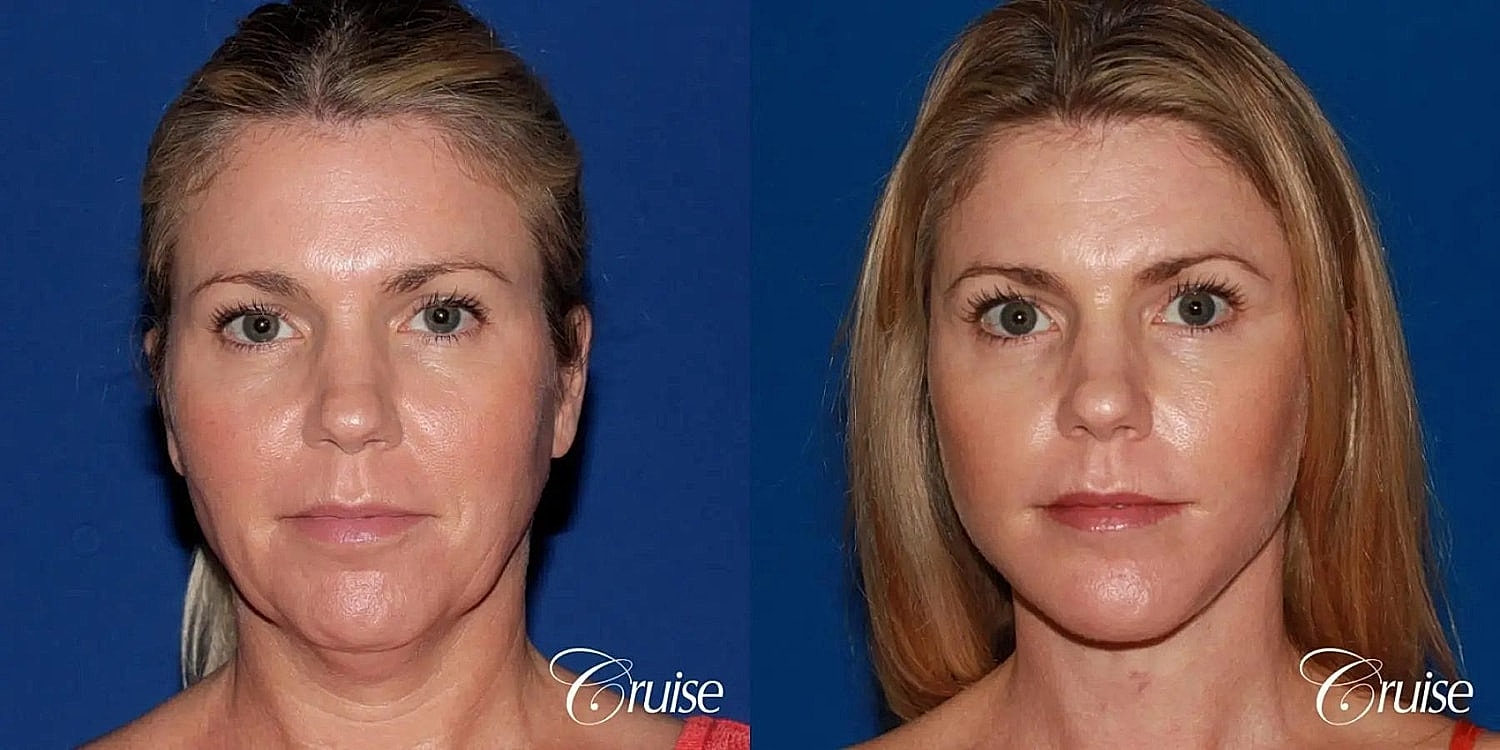 Face Lift Before & After