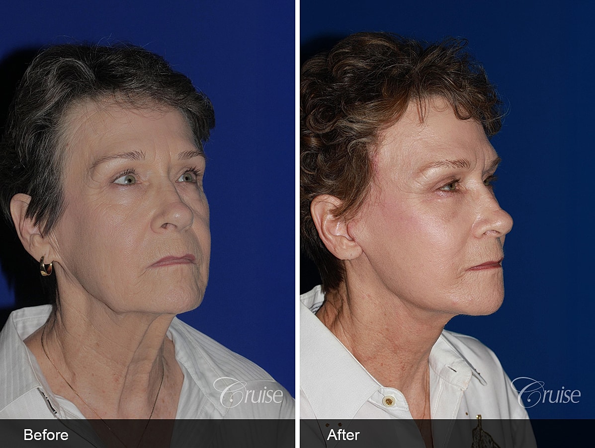 Face Lift Before & After