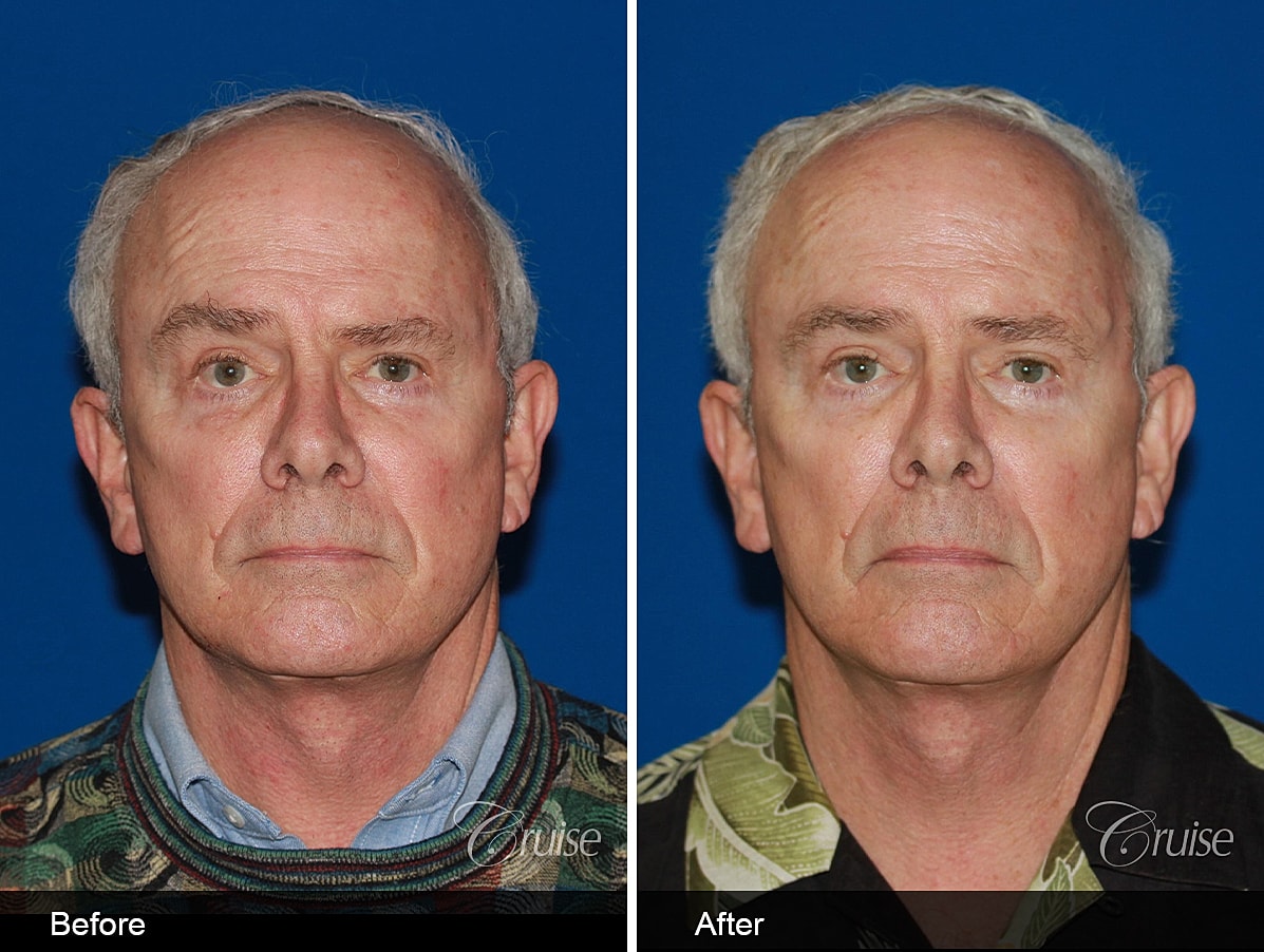 Face Lift Before & After