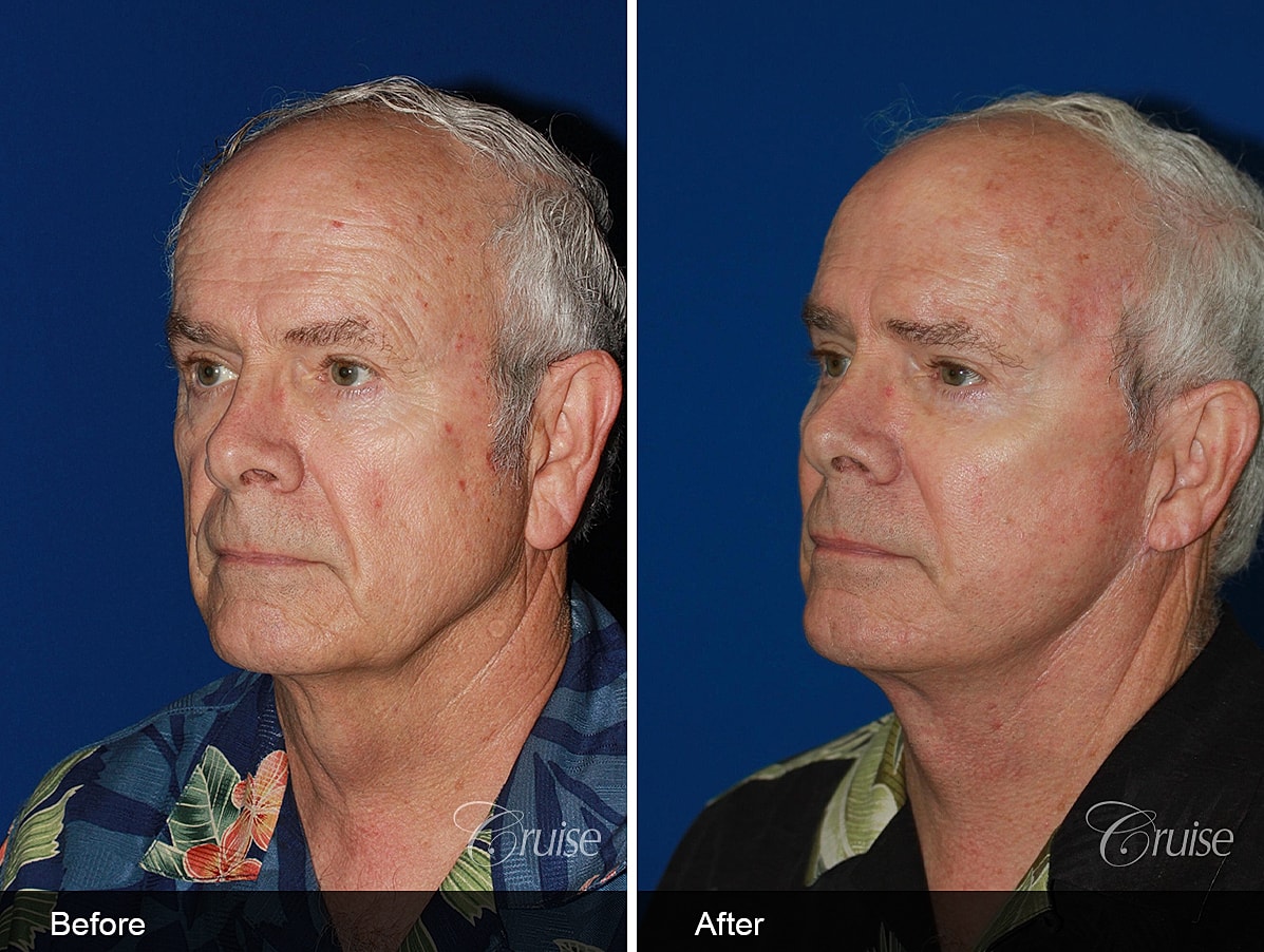 Face Lift Before & After