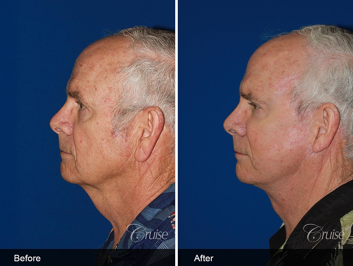 Face Lift Before & After