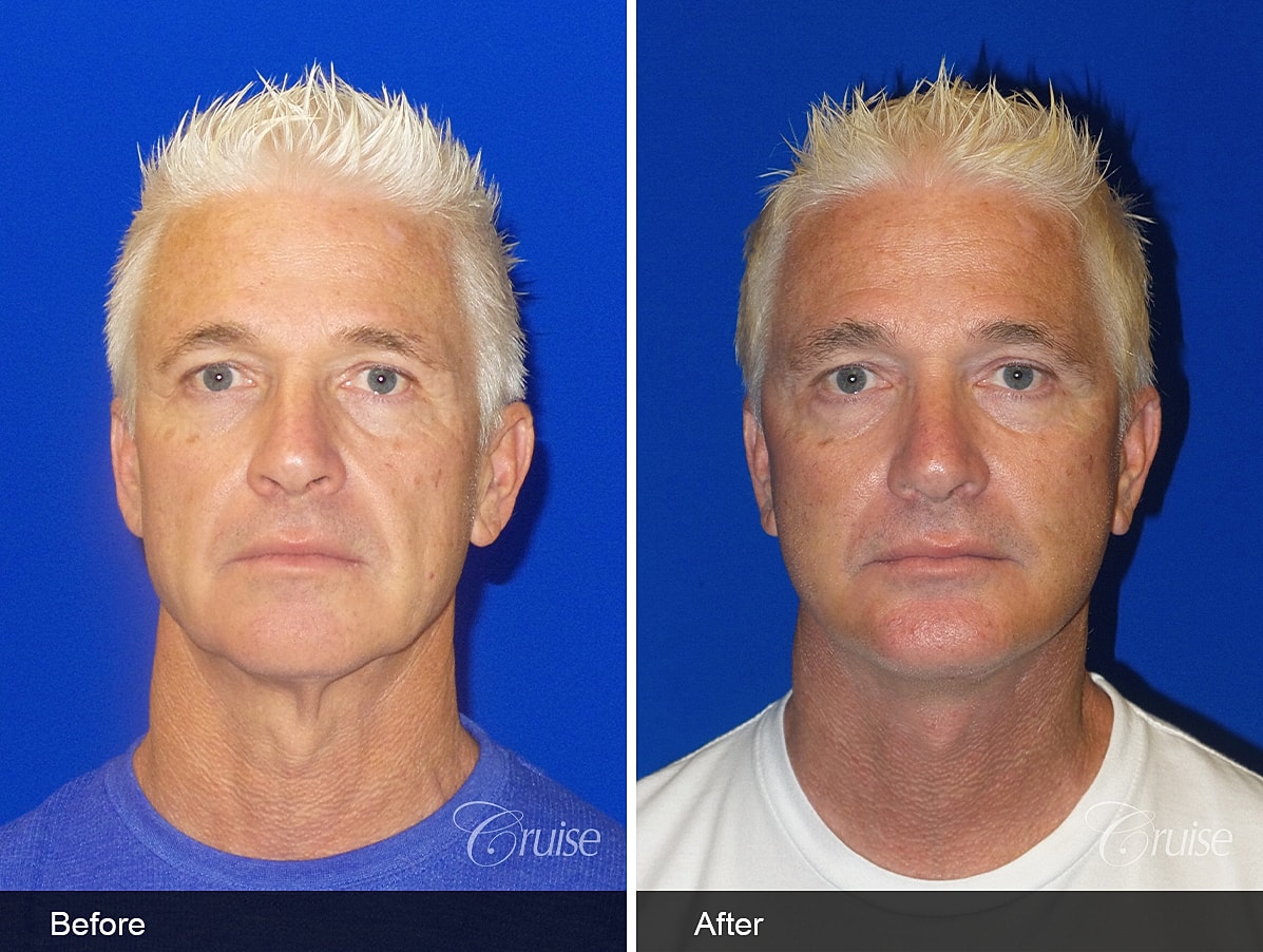 Face Lift Before & After