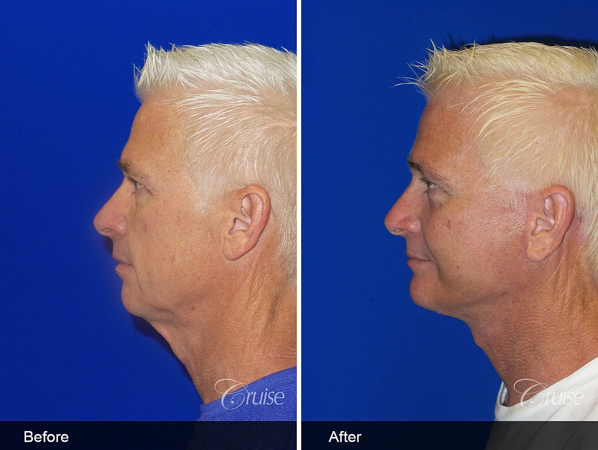 Face Lift Before & After