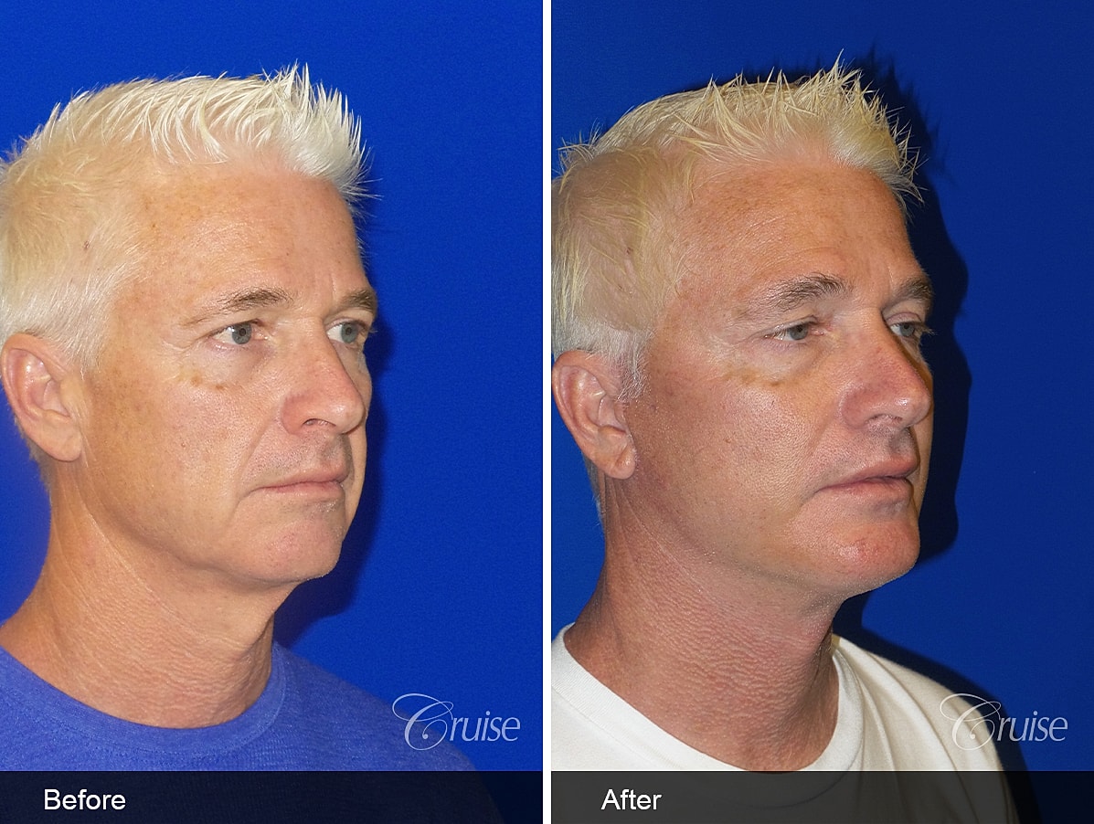 Face Lift Before & After