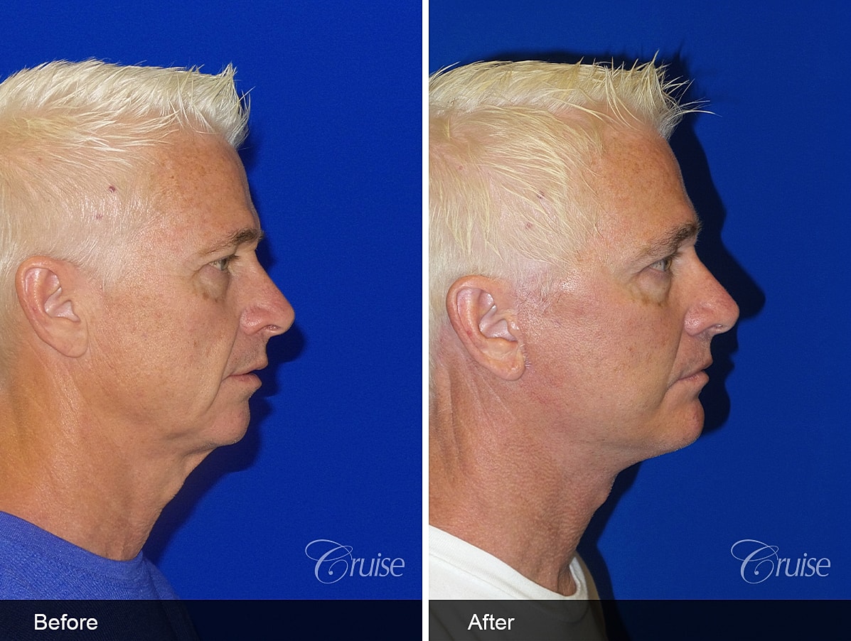 Face Lift Before & After