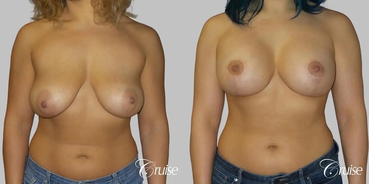 Breast Lift Augmentation Before & After