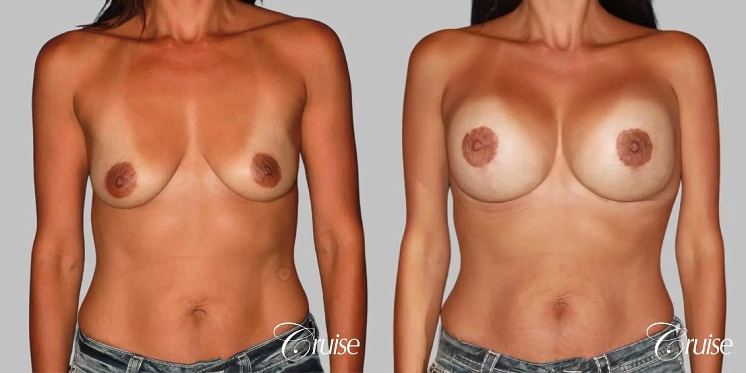 Breast Lift Augmentation Before & After