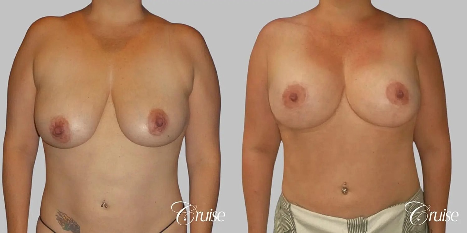 Breast Lift Augmentation Before & After