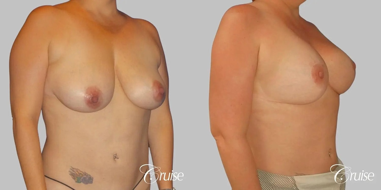 Breast Lift Augmentation Before & After