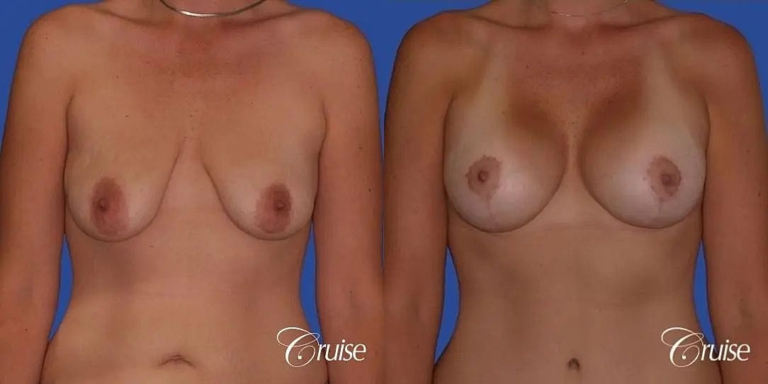 Breast Lift Augmentation Before & After