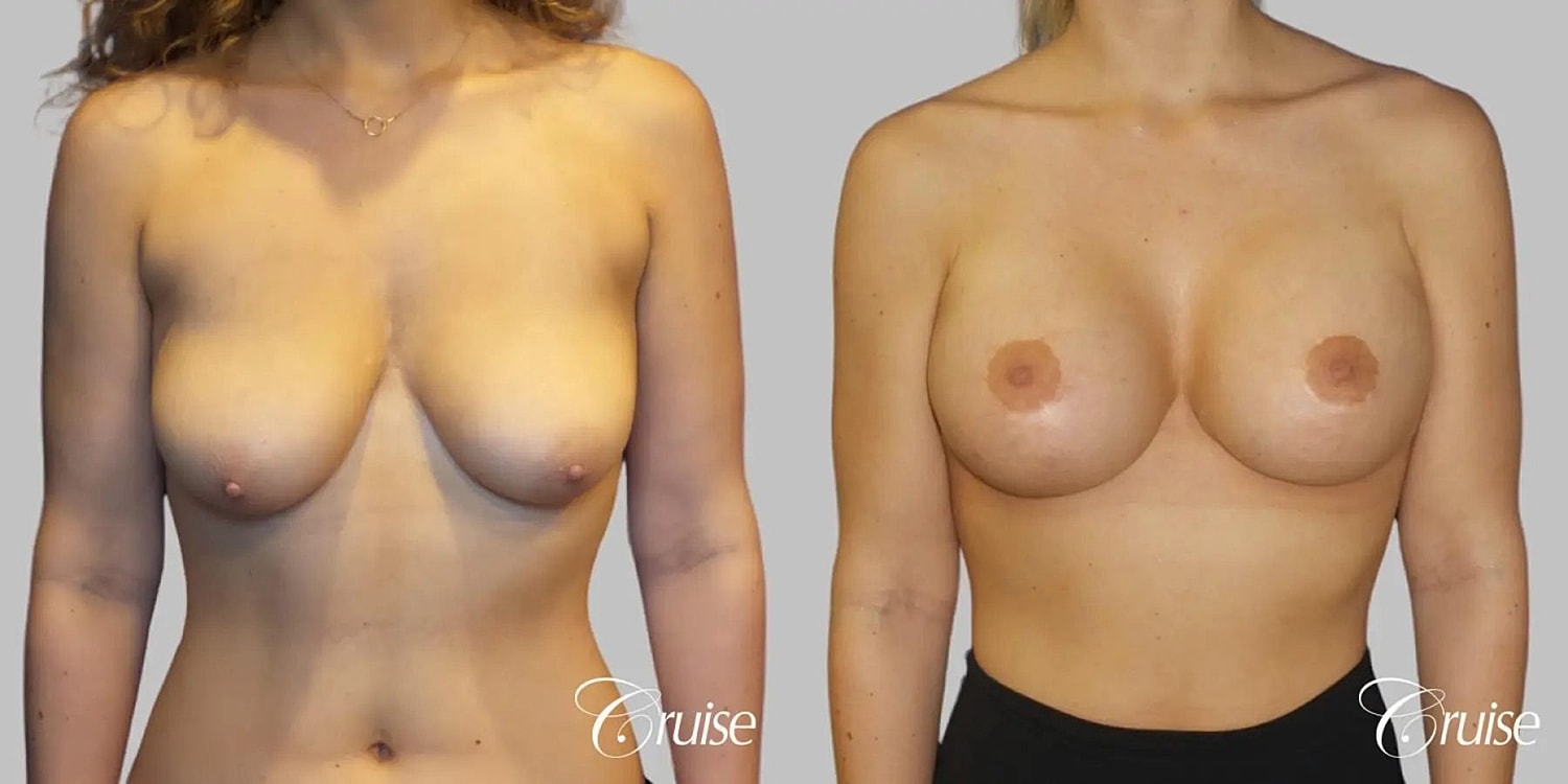 Breast Lift Augmentation Before & After