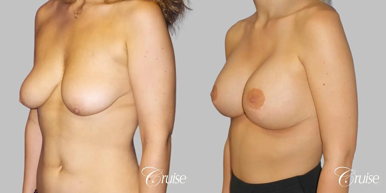 Breast Lift Augmentation Before & After