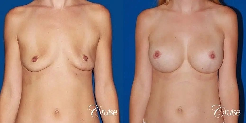 Breast Lift Augmentation Before & After