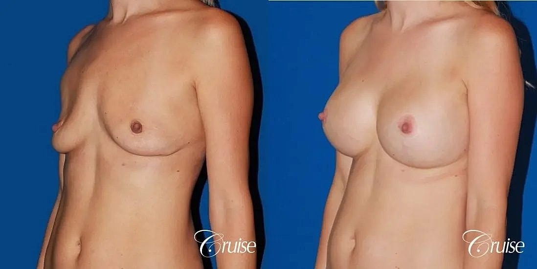 Breast Lift Augmentation Before & After