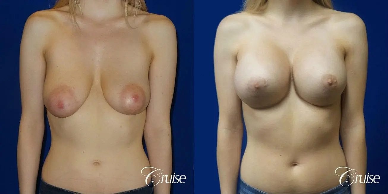 Breast Lift Augmentation Before & After