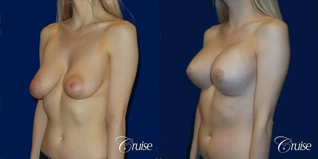 Breast Lift Augmentation Before & After