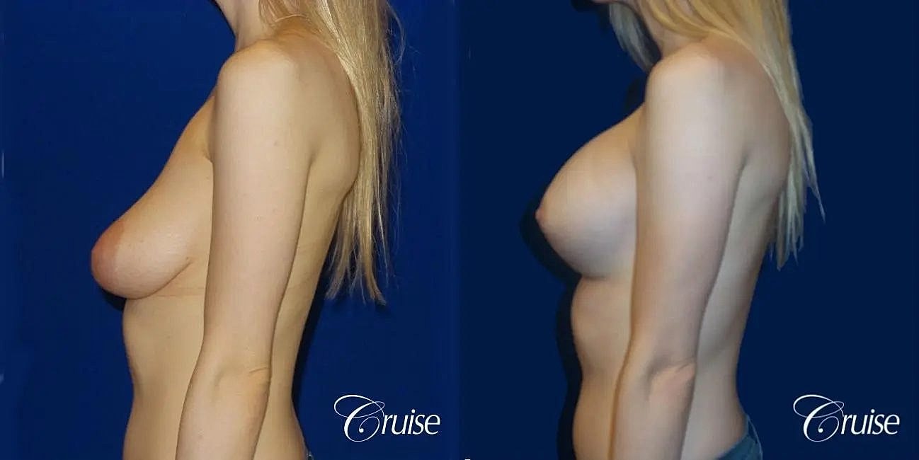 Breast Lift Augmentation Before & After