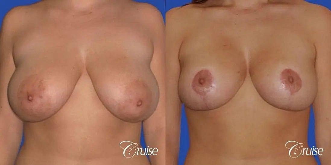 Breast Lift Augmentation Before & After