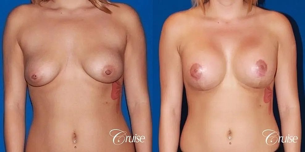 Breast Lift Augmentation Before & After