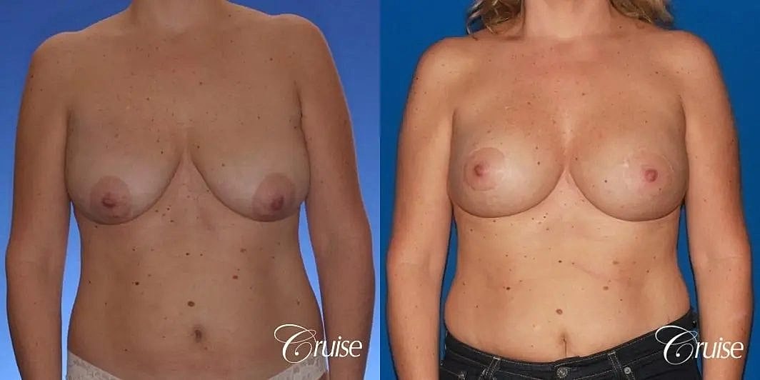 Breast Lift Augmentation Before & After