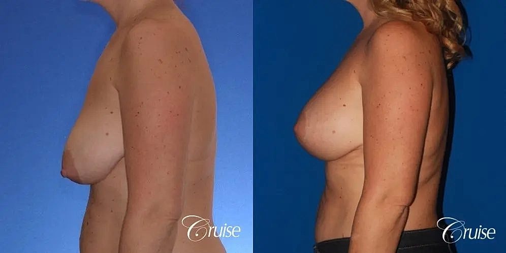 Breast Lift Augmentation Before & After