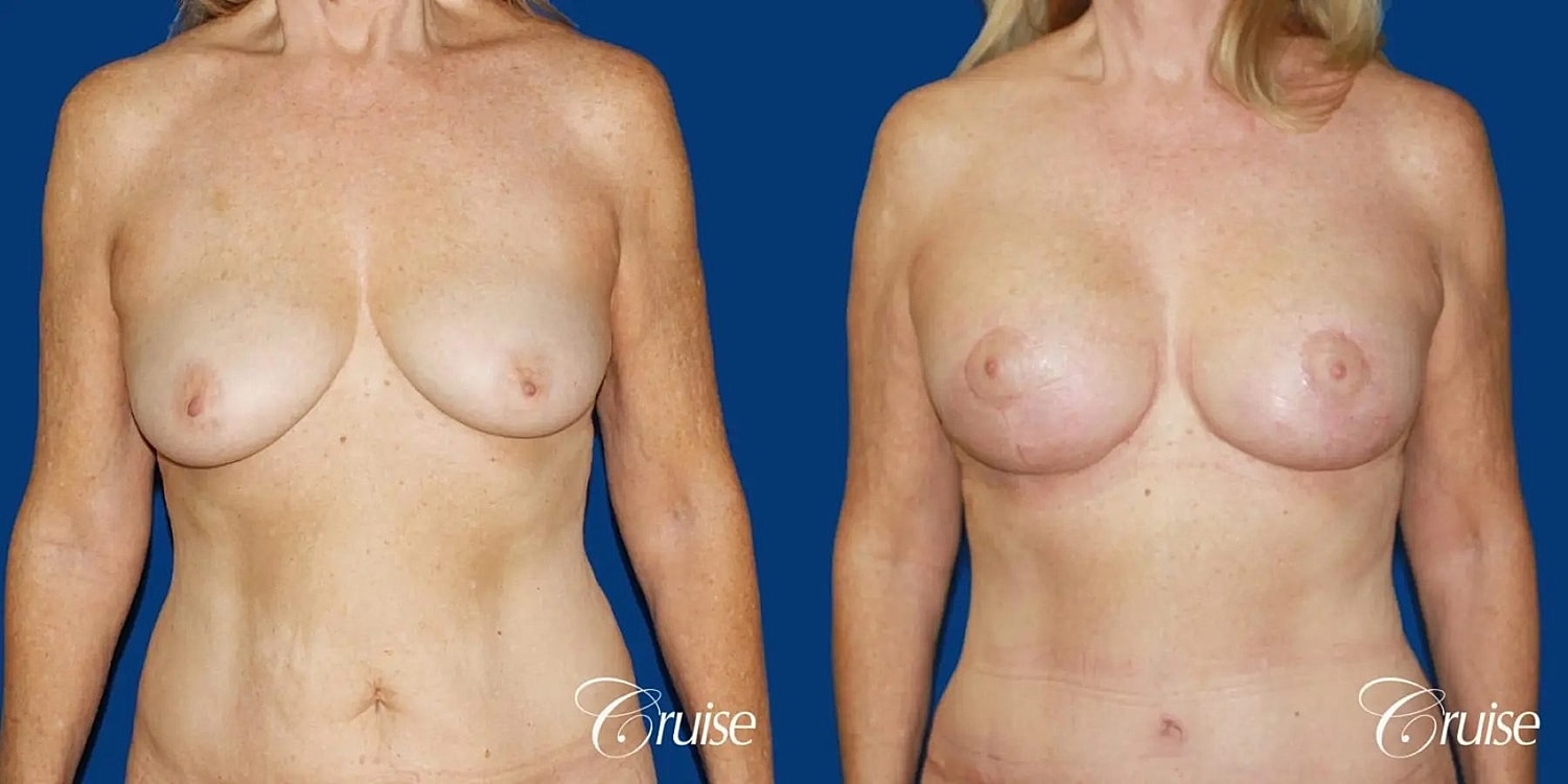 Breast Lift Augmentation Before & After