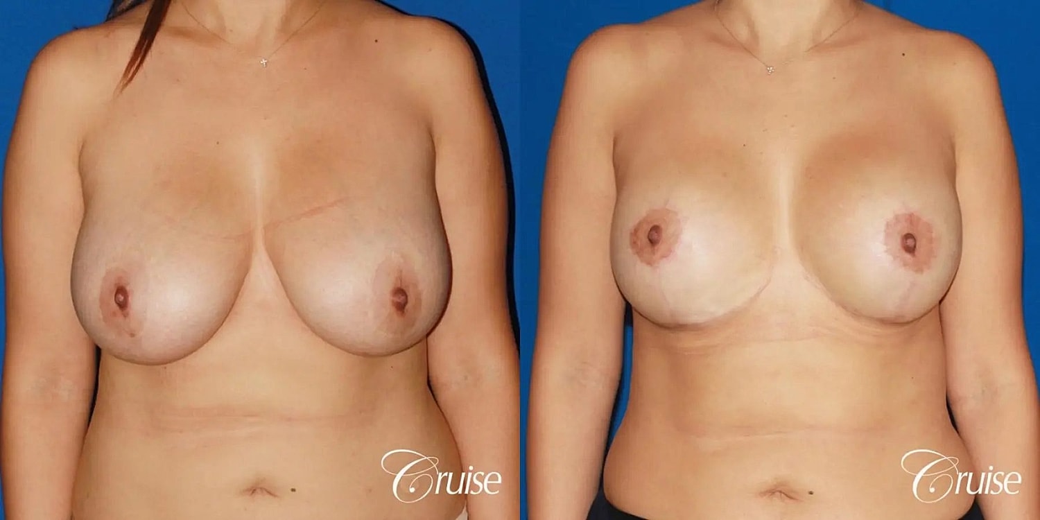 Breast Lift Augmentation Before & After