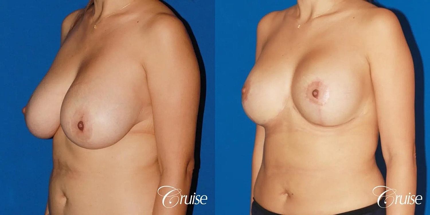 Breast Lift Augmentation Before & After