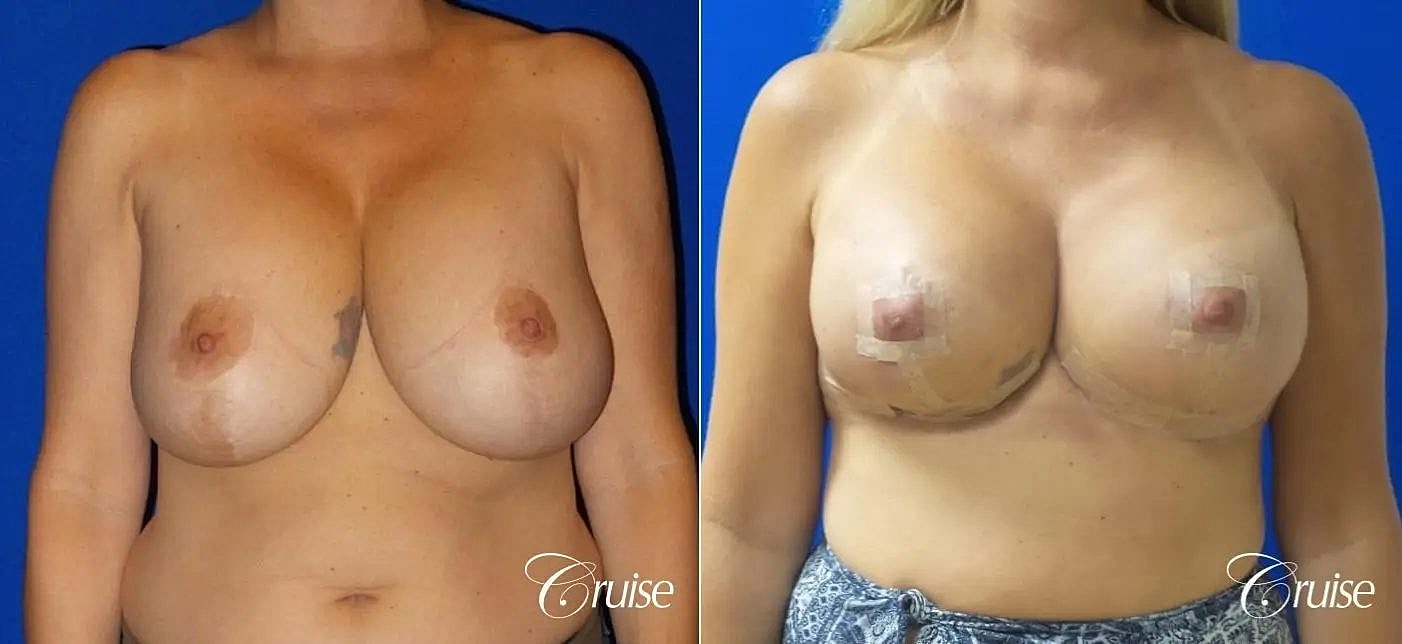 Breast Lift Augmentation Before & After