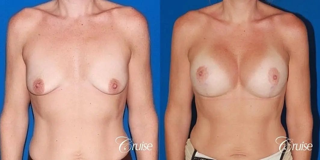 Breast Lift Augmentation Before & After