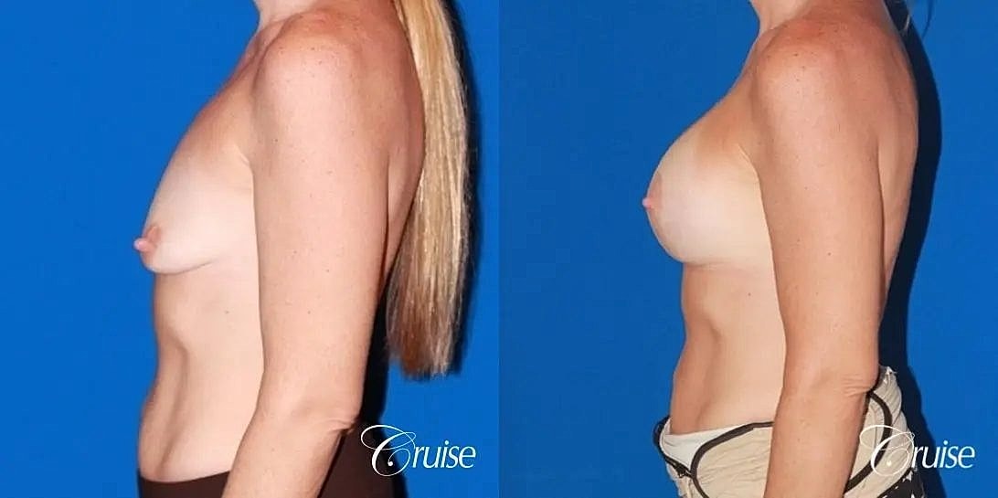 Breast Lift Augmentation Before & After