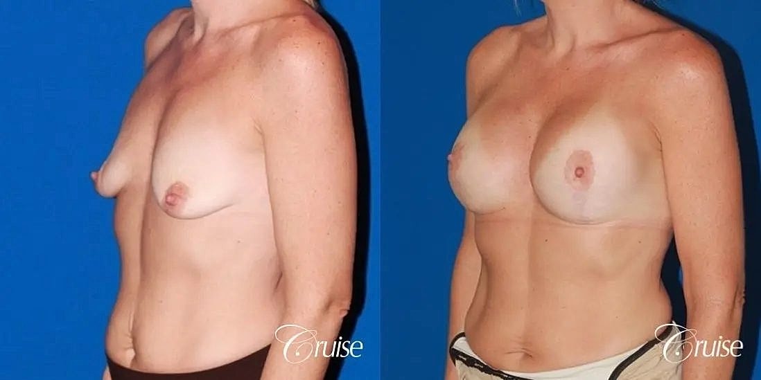 Breast Lift Augmentation Before & After