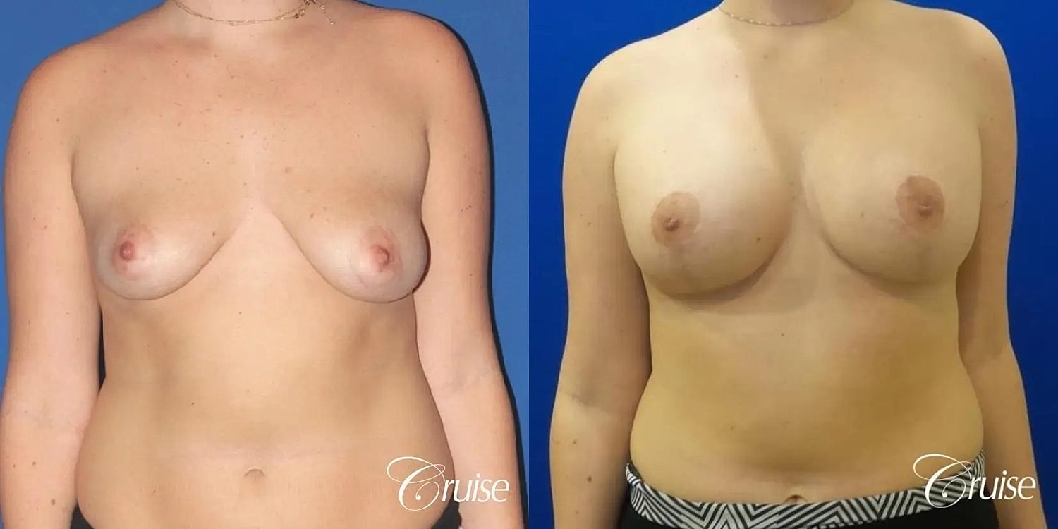 Breast Lift Augmentation Before & After