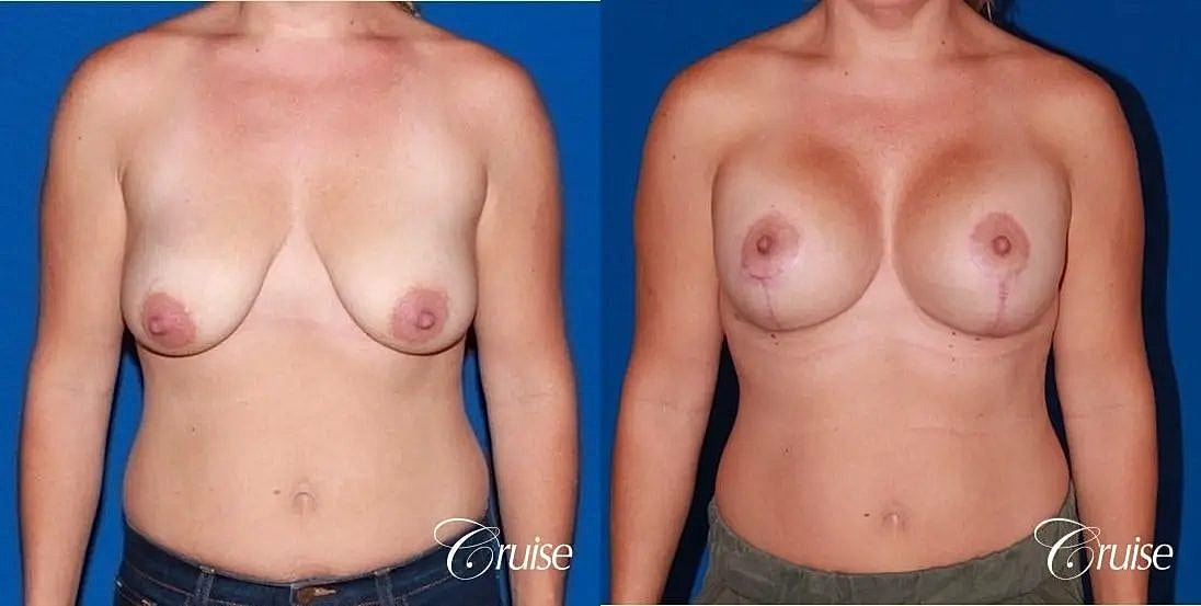 Breast Lift Augmentation Before & After