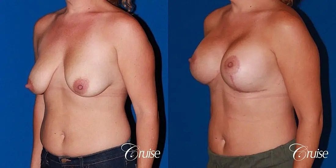 Breast Lift Augmentation Before & After