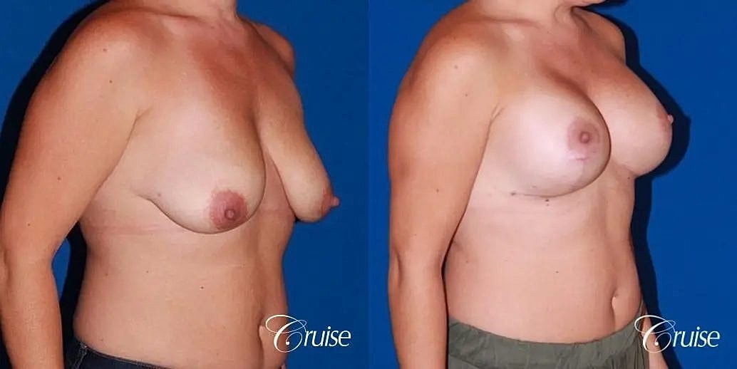 Breast Lift Augmentation Before & After
