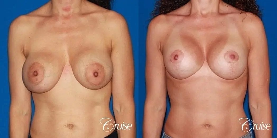 Breast Lift Augmentation Before & After
