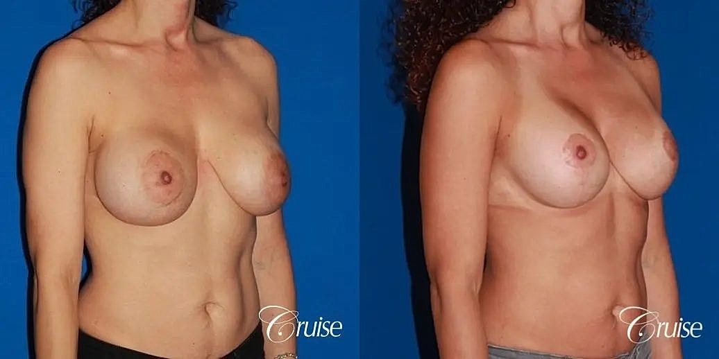 Breast Lift Augmentation Before & After