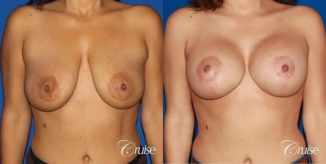 Breast Lift Augmentation Before & After